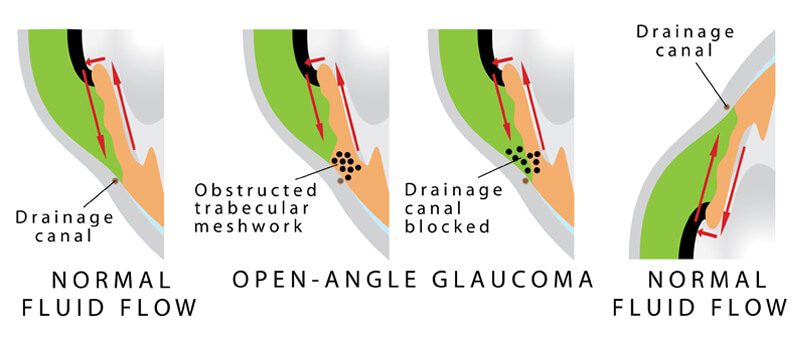 Open Angle Glaucoma | Minnesota Eye Consultants