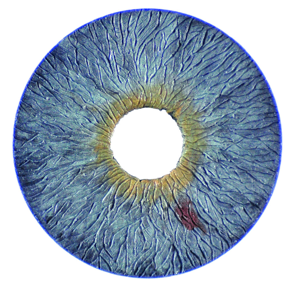 Now Fda Approved The Customflex® Artificial Iris Minnesota Eye Consultants 